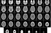 Científicos descubren canales secretos entre la médula ósea del cráneo y el cerebro