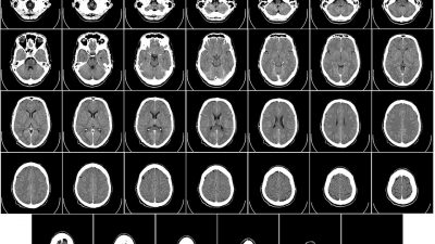 Científicos descubren canales secretos entre la médula ósea del cráneo y el cerebro