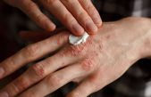 Un futuro libre de psoriasis es ‘casi’ posible