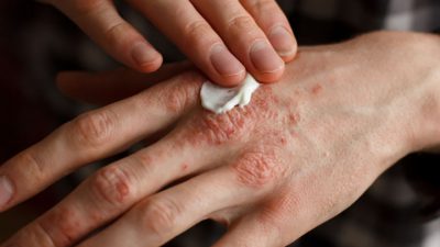 Un futuro libre de psoriasis es ‘casi’ posible