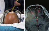 Médicos en China instalan ‘máquina de la felicidad’ en el cerebro de un paciente