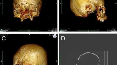 Hallan cráneos con deformación artificial de hace 1.500 años en Europa