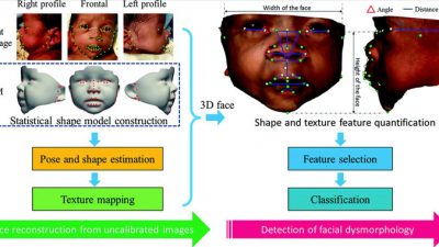 Un método de análisis facial detecta síndromes genéticos con alta precisión