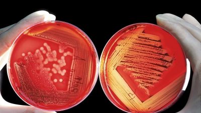 Alianza letal: dos cepas de bacterias ‘comecarne’ se combinan para causar una infección mortal