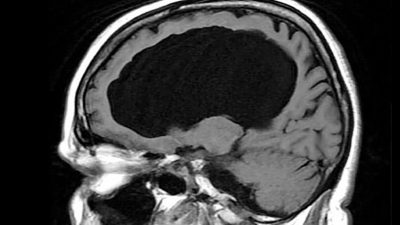 El caso del hombre (casi) sin cerebro pero con un IQ de 126