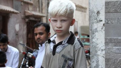 Día Internacional de Sensibilización sobre el Albinismo