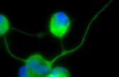 Generan neuronas mediante reprogramación directa a partir de las células de la piel de pacientes mitocondriales con el síndrome MELAS