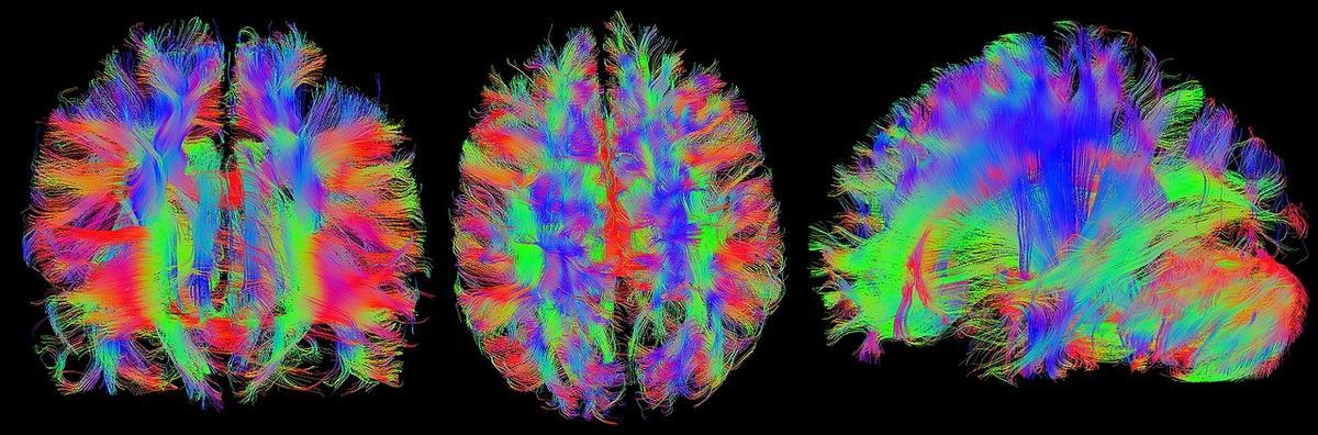 Las imágenes del cerebro pueden revelar lo que está pensando una persona