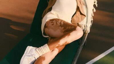 Día Mundial del Vitiligo